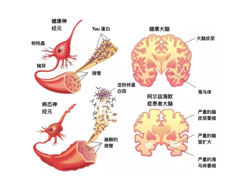 Read more about the article 一滴血预测阿尔茨海默病的发生